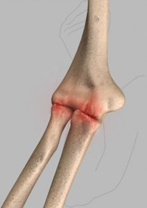 Wrist & Elbow Arthritis