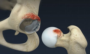 Hip Impingement