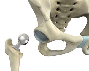 Partial Hip Replacement