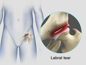 Labral Tear