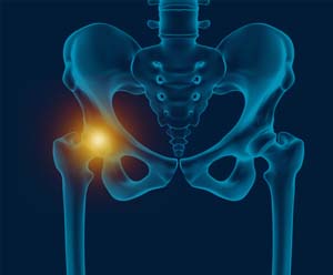 Hip Bursitis