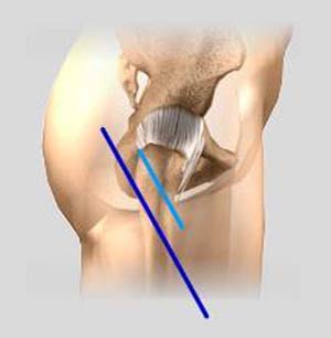 Hip Replacement Surgery