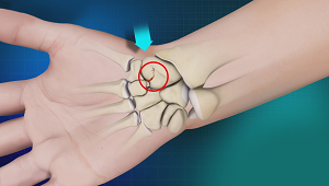 Scaphoid Fracture & Non-Union