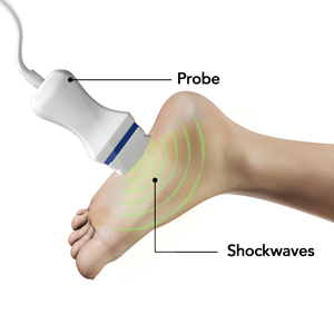 Shock Wave Therapy