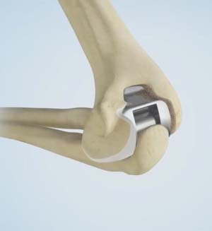 Elbow Replacement