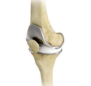 Knee Joint Replacement